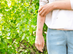 Woman in southern United States being bitten by mosquitos